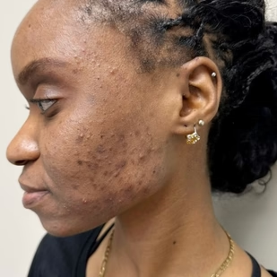 Week 1: Skin Feels More Balanced